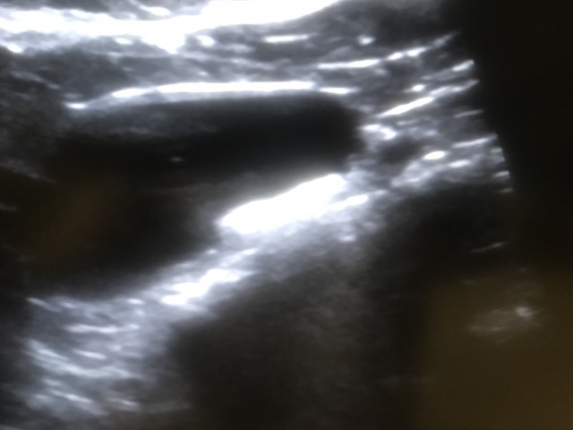 膀胱の超音波検査の様子