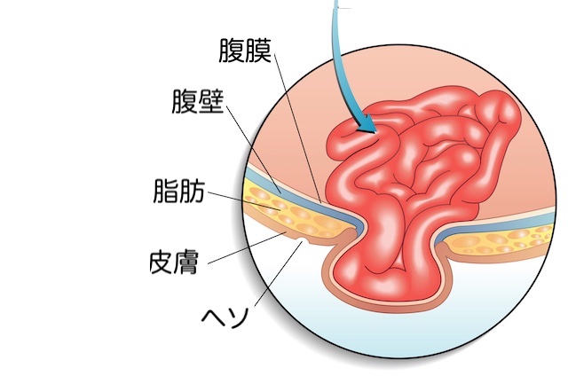 腹壁瘢痕ヘルニアのイラスト説明